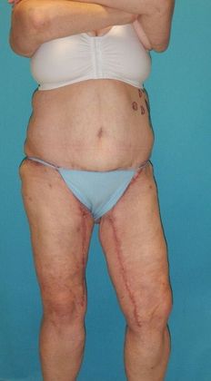 After Image: Thigh Lift: Case 6 - right-front-oblique