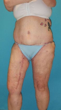 After Image: Thigh Lift: Case 6 - left-front-oblique