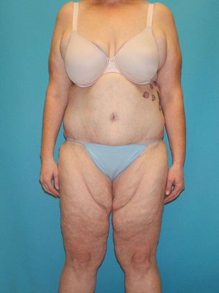 Before Image: Thigh Lift: Case 6 - front