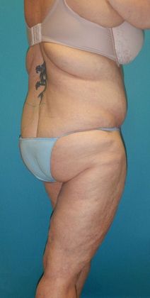 Before Image: Thigh Lift: Case 6 - right-back-oblique
