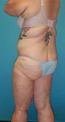 Before Image: Thigh Lift: Case 6 - left-back-oblique