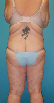 Before Image: Thigh Lift: Case 6 - back