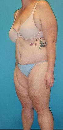 Before Image: Thigh Lift: Case 6 - left-front-oblique