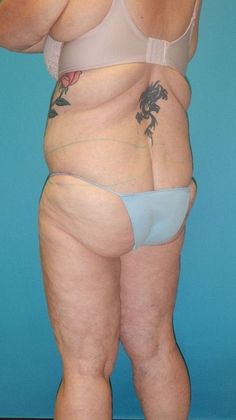 Before Image: Thigh Lift: Case 6 - left-back-oblique