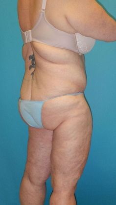 Before Image: Thigh Lift: Case 6 - right-back-oblique