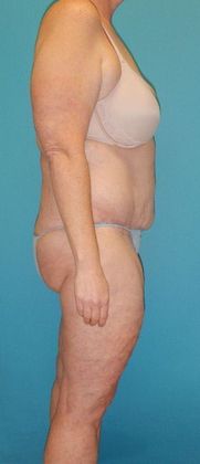 Before Image: Thigh Lift: Case 6 - right-side