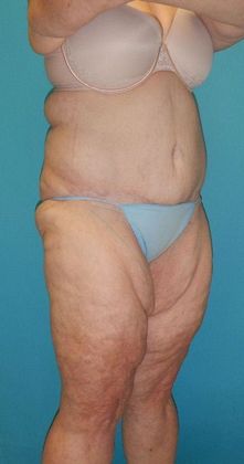 Before Image: Thigh Lift: Case 6 - right-front-oblique