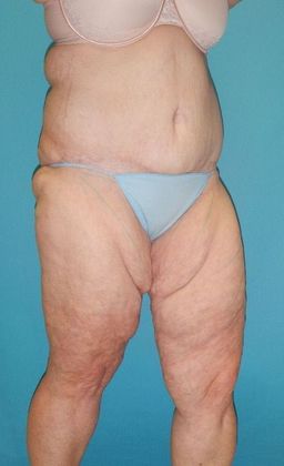 Before Image: Thigh Lift: Case 6 - right-front-oblique