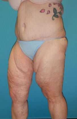 Before Image: Thigh Lift: Case 6 - left-front-oblique