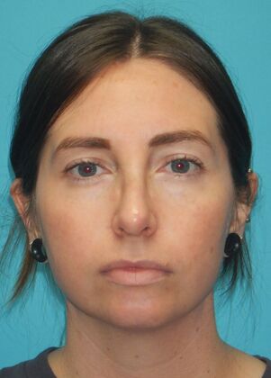 After Image: Rhinoplasty: Case 6 - front