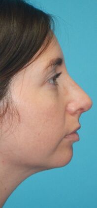 After Image: Rhinoplasty: Case 6 - right-side