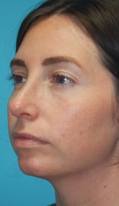After Image: Rhinoplasty: Case 6 - left-front-oblique