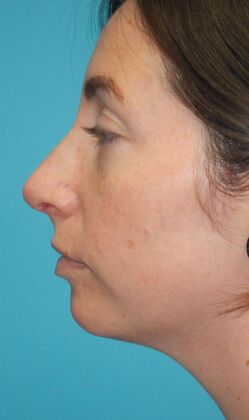 After Image: Rhinoplasty: Case 6 - left-side
