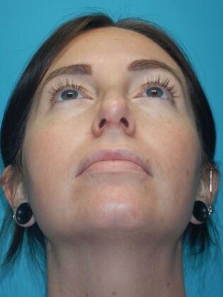 After Image: Rhinoplasty: Case 6 - front