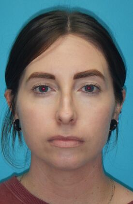 Before Image: Rhinoplasty: Case 6 - front