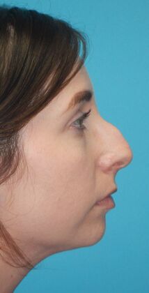 Before Image: Rhinoplasty: Case 6 - right-side