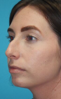Before Image: Rhinoplasty: Case 6 - left-front-oblique