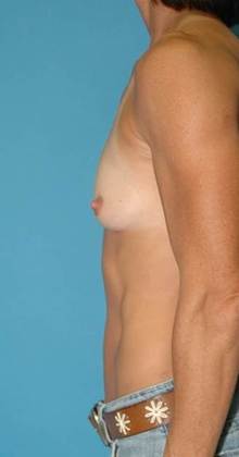 Before Image: Breast Augmentation: Case7 - left-side