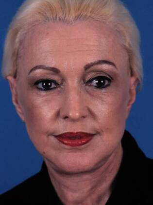 After Image: Face & Neck Lifts: Case 7 - front