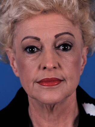 Before Image: Face & Neck Lifts: Case 7 - front