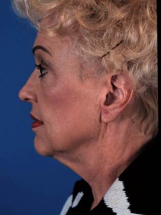Before Image: Face & Neck Lifts: Case 7 - left-side