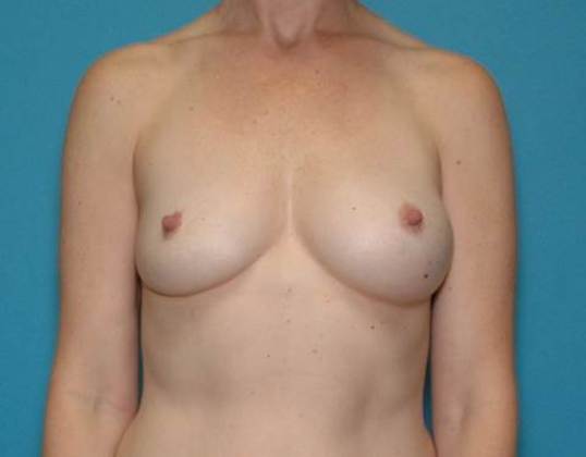 Before Image: Breast Lift Augmentation: Case 7 - front