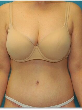After Image: Abdominoplasty: Case 7 - front