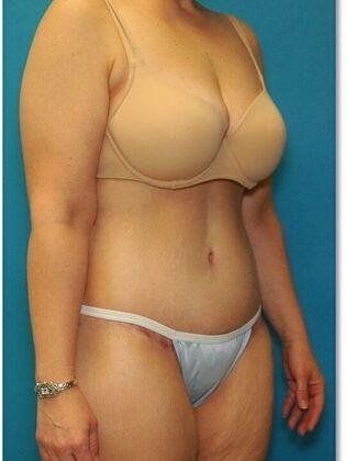After Image: Abdominoplasty: Case 7 - right-front-oblique