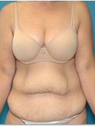Before Image: Abdominoplasty: Case 7 - front