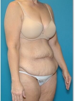 Before Image: Abdominoplasty: Case 7 - right-front-oblique