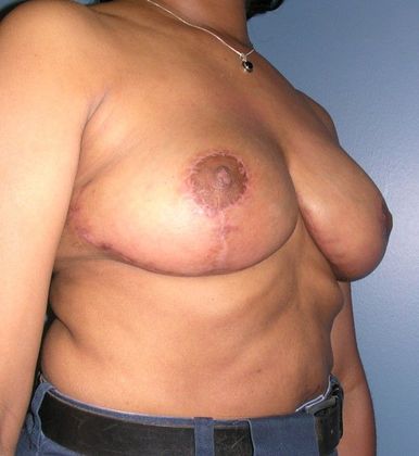 After Image: Breast Reduction: Case 7 - right-front-oblique