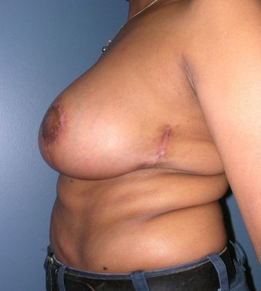 After Image: Breast Reduction: Case 7 - left-side