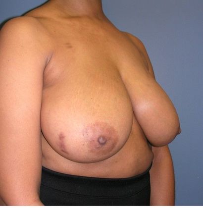 Before Image: Breast Reduction: Case 7 - right-front-oblique