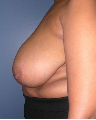 Before Image: Breast Reduction: Case 7 - left-side