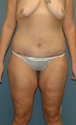 After Image: Body Lifts: Case 7 - front