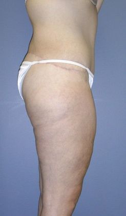 After Image: Body Lifts: Case 7 - right-side