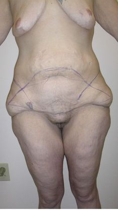 Before Image: Body Lifts: Case 7 - front