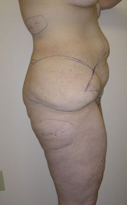 Before Image: Body Lifts: Case 7 - right-side