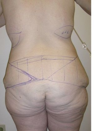 Before Image: Body Lifts: Case 7 - back