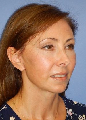 After Image: Mini Facelift: Case 7 - right-front-oblique