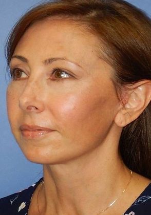 After Image: Mini Facelift: Case 7 - left-front-oblique