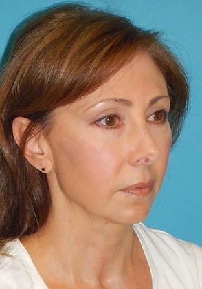 Before Image: Mini Facelift: Case 7 - right-front-oblique