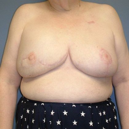 After Image: Breast Reconstruction: Case 7 - front
