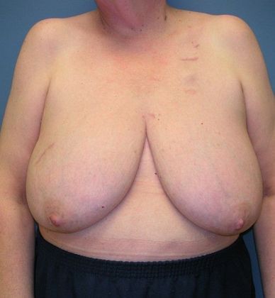 Before Image: Breast Reconstruction: Case 7 - front