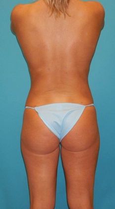 After Image: Brazilian Butt Lift: Case 7 - back