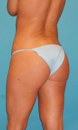 After Image: Brazilian Butt Lift: Case 7 - left-back-oblique