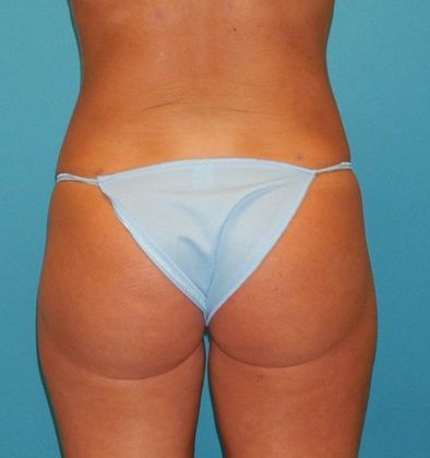 After Image: Brazilian Butt Lift: Case 7 - back