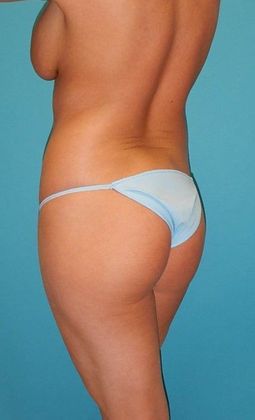 Before Image: Brazilian Butt Lift: Case 7 - left-back-oblique
