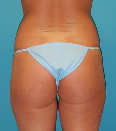 Before Image: Brazilian Butt Lift: Case 7 - back