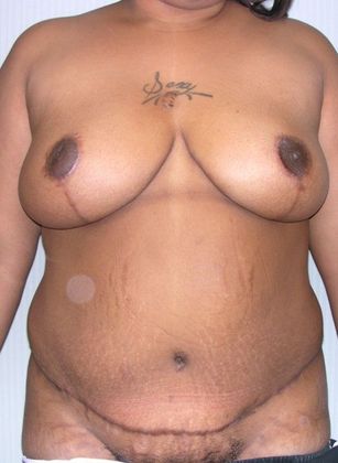 After Image: Mommy Makeover: Case 7 - front